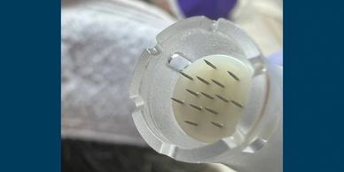 Skinpen microneedling treatment, for collagen induction therapy, in Hawarden, deeside, Chester