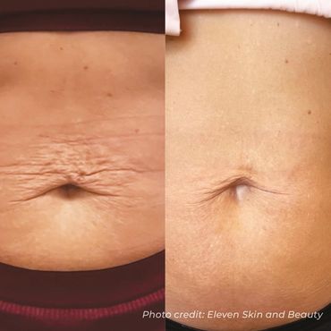 Before and after RF microneedling skin tightening treatment i
RF microneedling for loose skin