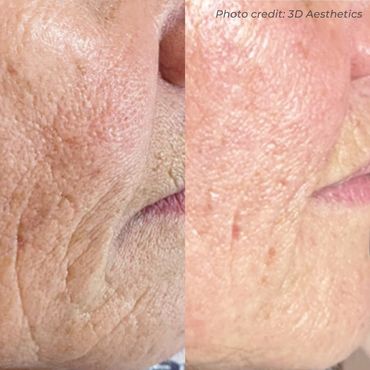 Before and after 3D Dermaforce RF microneedling treatment in Flintshire