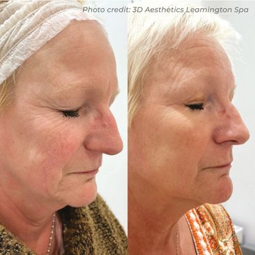 Skin Rejuvenation
Visible improvements in skin quality, texture and overall complexion following tre