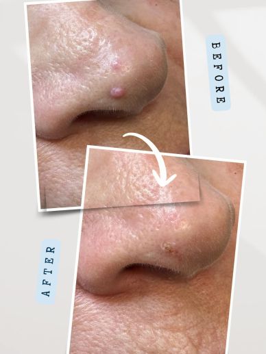 Before and after sebaceous hyperplasia removal treatment to nose in Hawarden, Flintshire