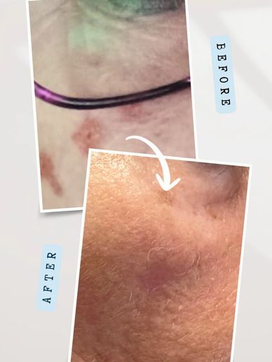 Before and after sun spot removal treatment in Hawarden, Flintshire