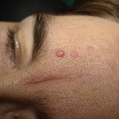 Treatment results for enlarged sebaceous glands
