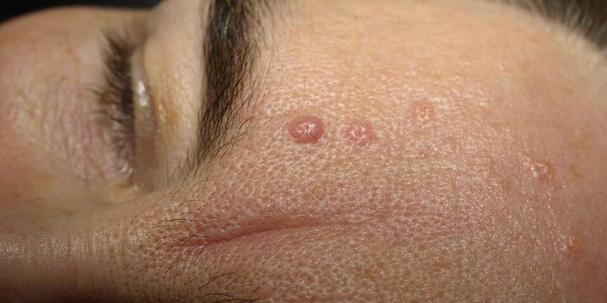 Instant sebaceous hyperplasia removal to face hawarden, Deeside, Chester, wirral, before and after