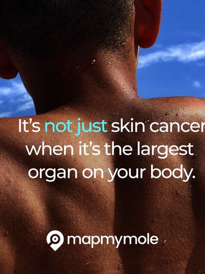 Checking mole for cancer 
map my mole
get your skin checked