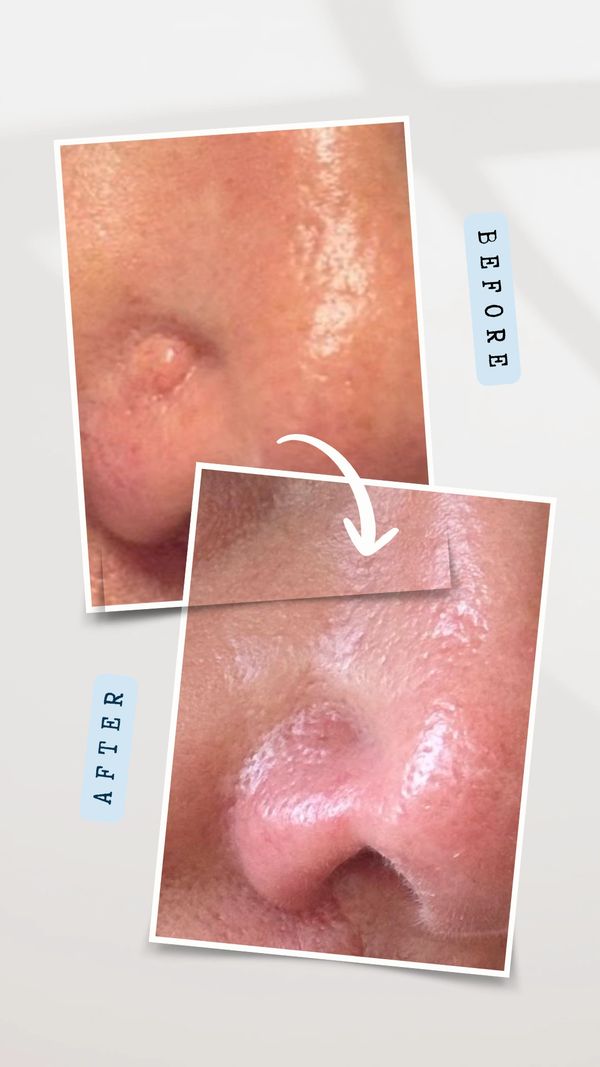 Mole on the Nose
Benign mole removal results showing improvement in facial appearance
