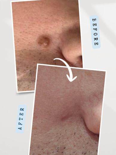 Before and after benign mole reduction treatment on the face in Hawarden, Flintshire