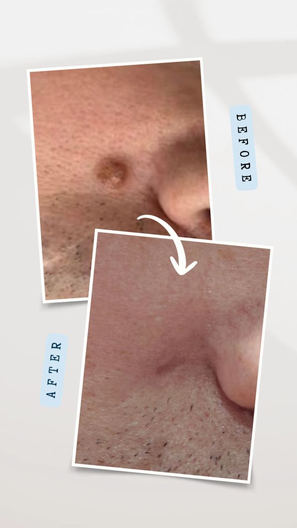 Facial Mole Removal
Before and after cosmetic benign mole removal treatment