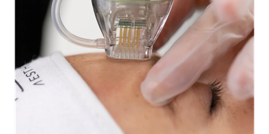 Skin tightening treatment
Wrinkle reduction