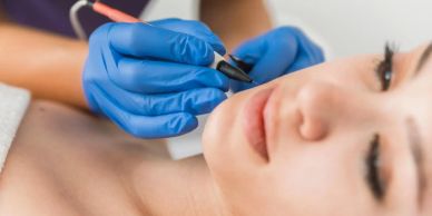 Removal of enlarged oil glands using advanced electrolysis
Sebaceous hyperplasia treatment results s