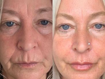 Skin booster injection