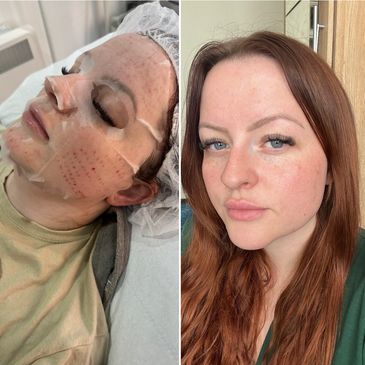 Mesotherapy
