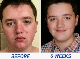 A 6-week unbelievable transformation to a completely cleared up face from acne.
