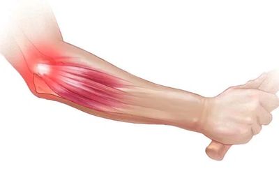 Tennis Elbow Natural Therapies with Soo can help