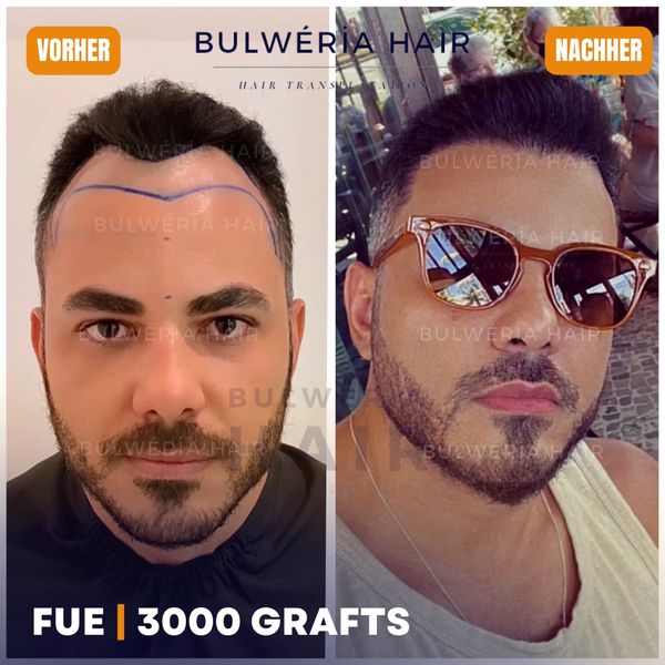 Vorher Nachher nach 1 Jahr, FUE DHI Ergebnisse, 4500 Grafts Ergebnisse, Beste Ergebnisse