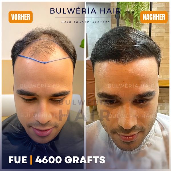 Vorher Nachher nach 1 Jahr, FUE DHI Ergebnisse, 4500 Grafts Ergebnisse, Beste Ergebnisse