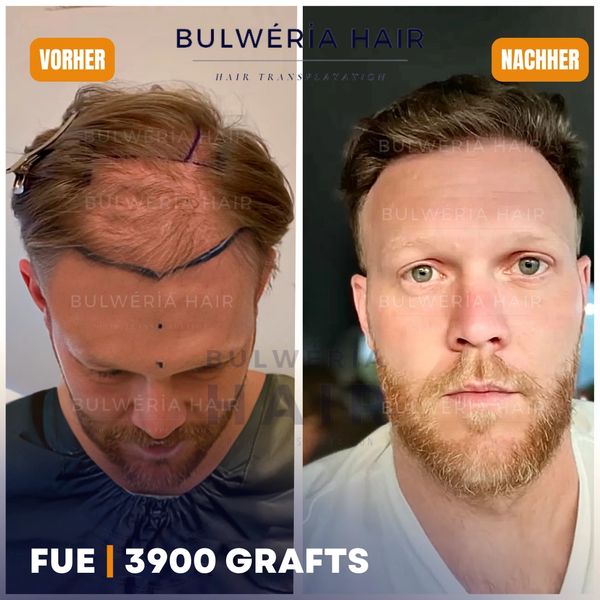 Kö Hair Ergebnisse, Haartransplantation Ergebnisse nach 9 Monaten, 5000 Grafts FUE, Vorher Nachher
