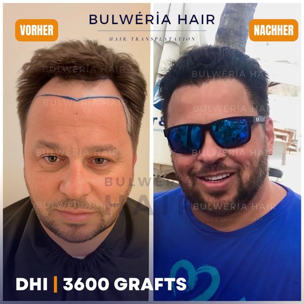 Vorher Nachher nach 1 Jahr, FUE DHI Ergebnisse, 4500 Grafts Ergebnisse, Beste Ergebnisse