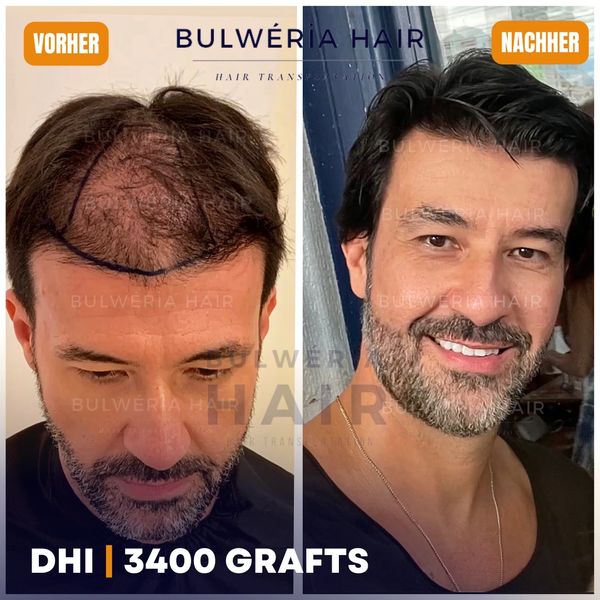 Haartransplantation Endergebnis, Haartransplantation beste Ergebnisse, Hairmedic Ergebnisse