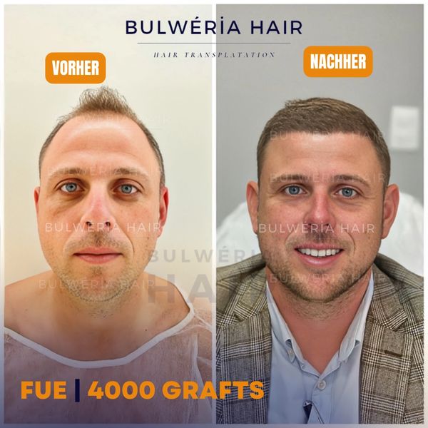 Haartransplantation Ergebnisse, 4000 Grafts Kosten, Haartransplantations Ergebnisse nach 5 Monaten