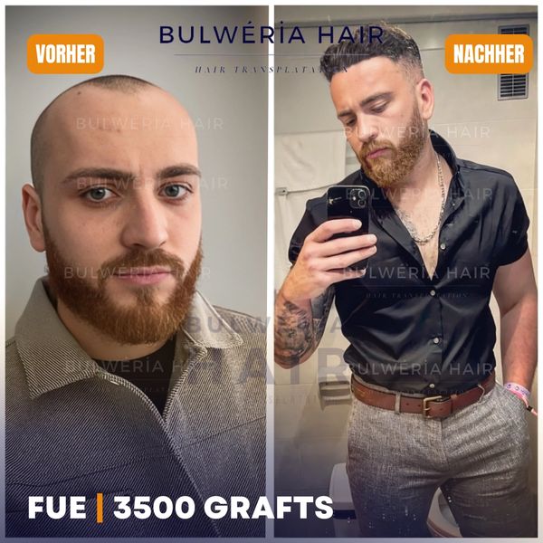 Elithair Ergebnisse, Haartransplantation Resultate 3500 Grafts, Haartransplantation beste Ergebnisse