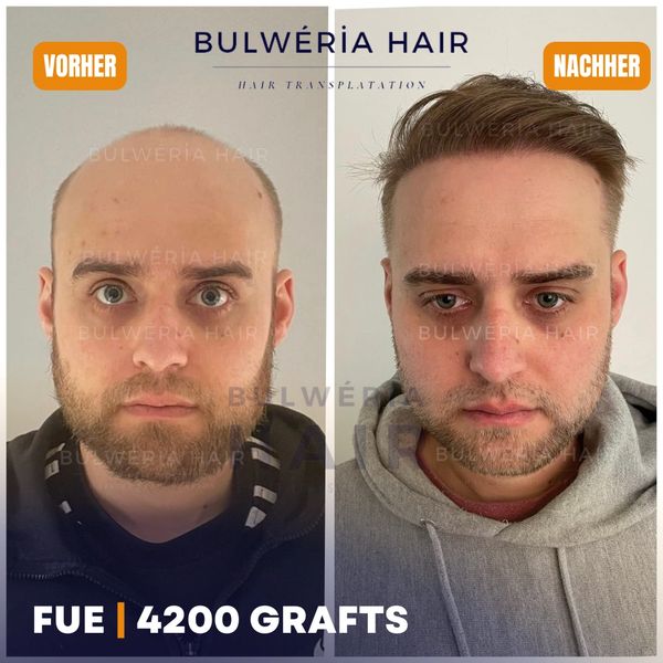Haartransplantation Vorher Nachher FUE Vorher Nachher Haartransplantation 6000 Grafts Vorher Nachher