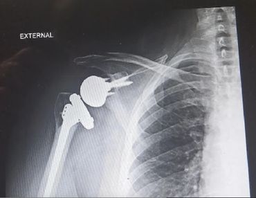 Right Shoulder Broken and Shattered from Bad Fall in 2016. Complete Reverse Shoulder Replacement.