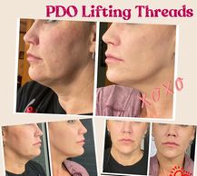 Non-surgical lifting with PDO Threads, Stimulate collagen, No Down Time, Instant Lifting results. 
