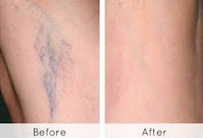 Treatment of spider veins with Asclera Injections. Aesthetic injectable MedSpa Sclerotherapy 