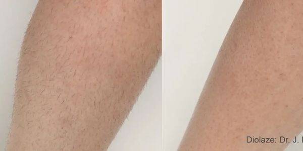 Goodbye unwanted hair with Diolaze Laser Hair Removal, InMode. Aesthetic injectable MedSpa 