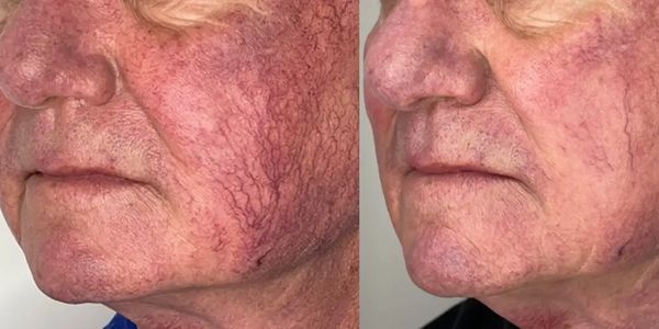 Lumecca IPL (Intense Pulsed Light) for removal of sun damage, sun spots, age spots, and spider veins