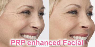 PRP enhanced facial. Micro-Needling with PRP added services for best results