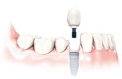 Screw Retained Dental Implant