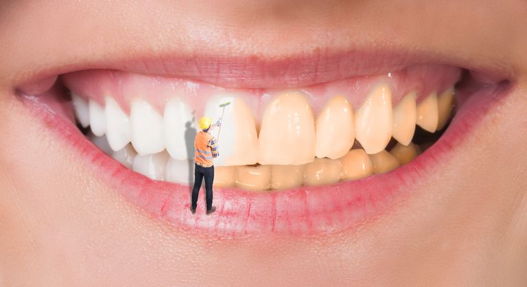 DFW Teeth Whitening Gainesville Bleach Whitening Muenster Laser Whitening Lewisville Whitening