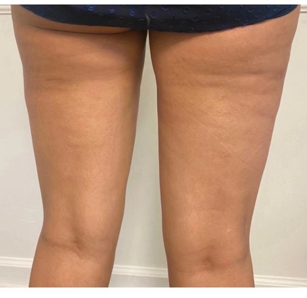 Profound-RF After for Cellulite
