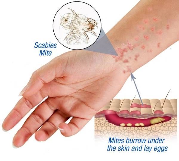 Scabies Perlu Dirawat Sebelum Merebak