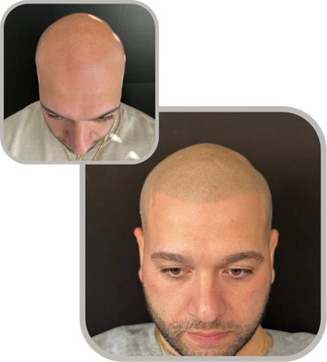 Before & After Scalp Micropigmentation