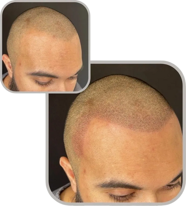 Professional scalp micropigmentation before and after results for natural hair look