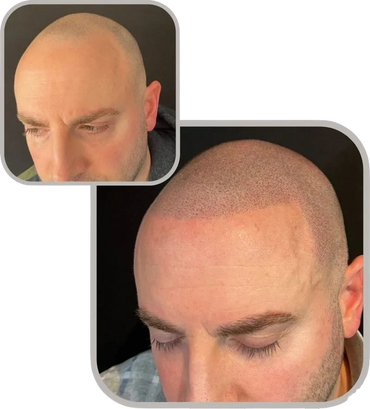 Non-surgical hair loss treatment—scalp micropigmentation before and after results