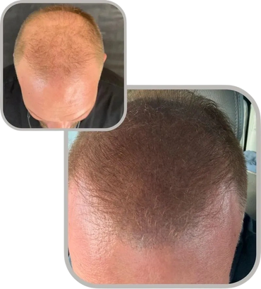 Real patient results: before and after scalp micropigmentation for receding hairline