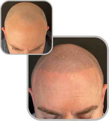 Hair density restoration with scalp micropigmentation before and after pictures