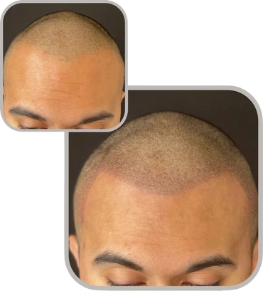 Confidence boost shown in before and after scalp micropigmentation transformation