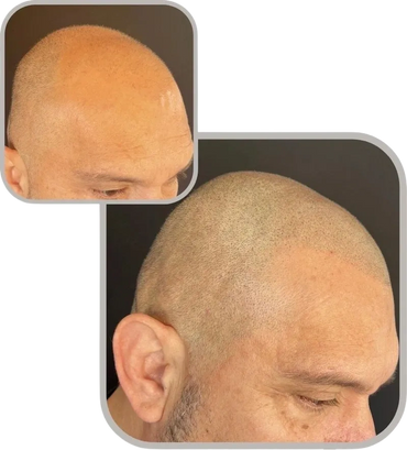 Hair restoration transformation with scalp micropigmentation before and after