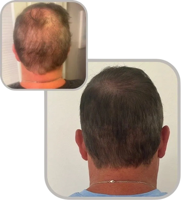 Hair loss treatment before and after with scalp micropigmentation procedure