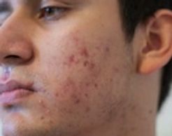 Bundle of various treatments to address acne,acne hyperpigmentation and scaring
