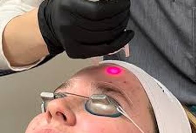 Laser facial