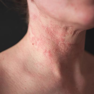 a close up of a female neck that shows signs of dermatitis