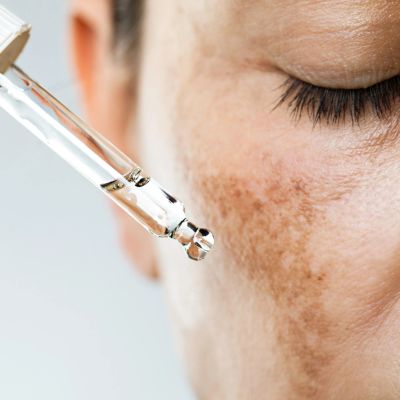 an image of a female applying a serum to a hyperpigmentation on her cheek