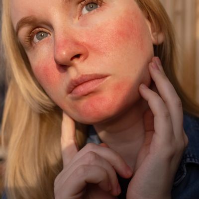 a portrait of a female with rosacea and redness around her face