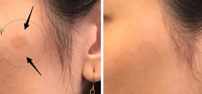 A before and after of a dark spot removed by laser dark spot removal In Ann Arbor